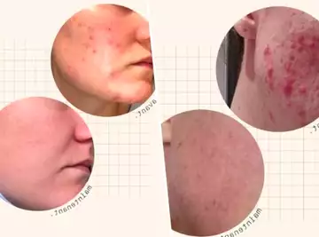 Skin & Out : cette marque française qui éradique l'acné est au centre d'un énorme buzz sur Instagram