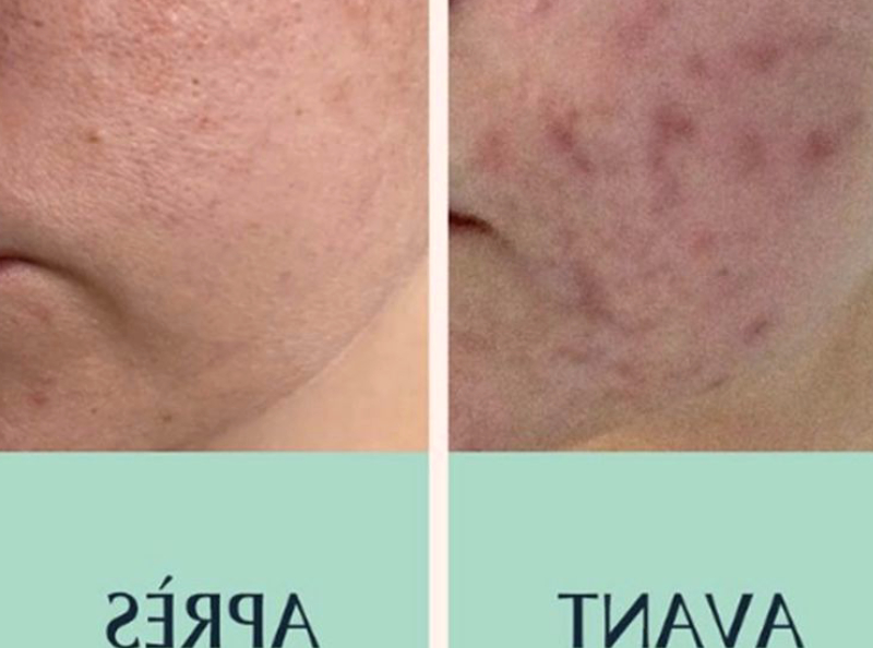 Soins du visage : ce sérum réduit les taches pigmentaires post-acné de 80% en seulement 2 semaines... et il coûte moins de 14E !